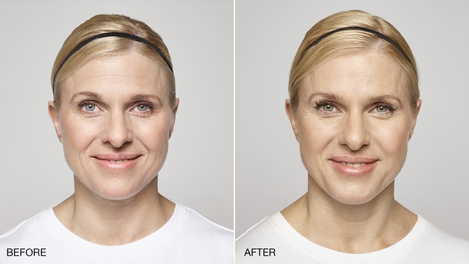 Restylane treatment