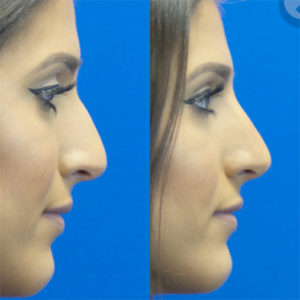 Liquid Rhinoplasty Using Restylane